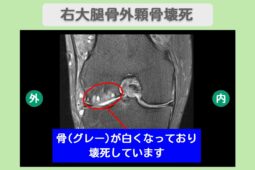 右大腿骨外顆骨壊死
