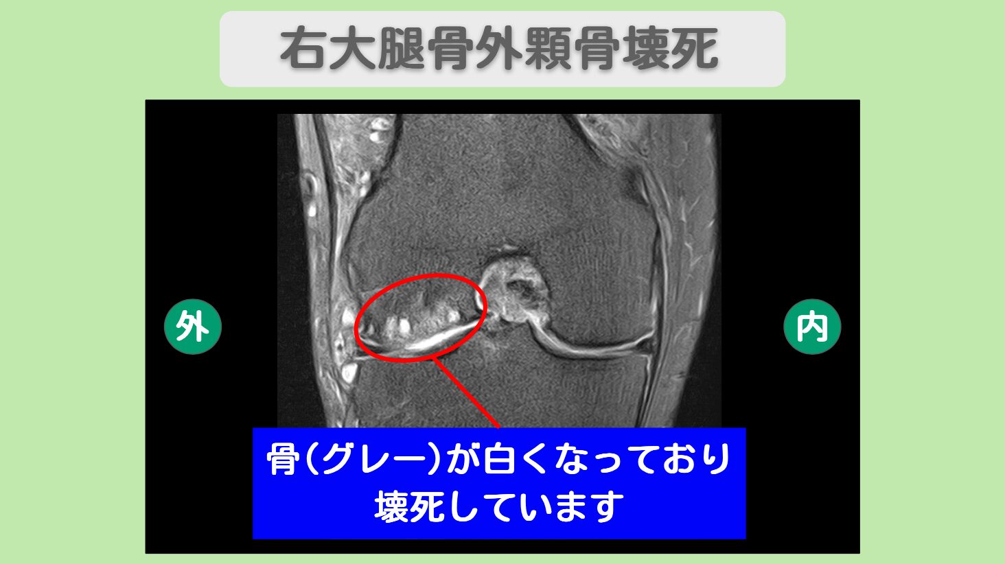 右大腿骨外顆骨壊死