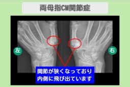 両母指CM関節症