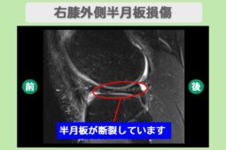 右膝外側半月板損傷