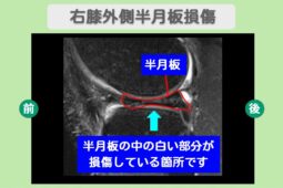 半月板損傷