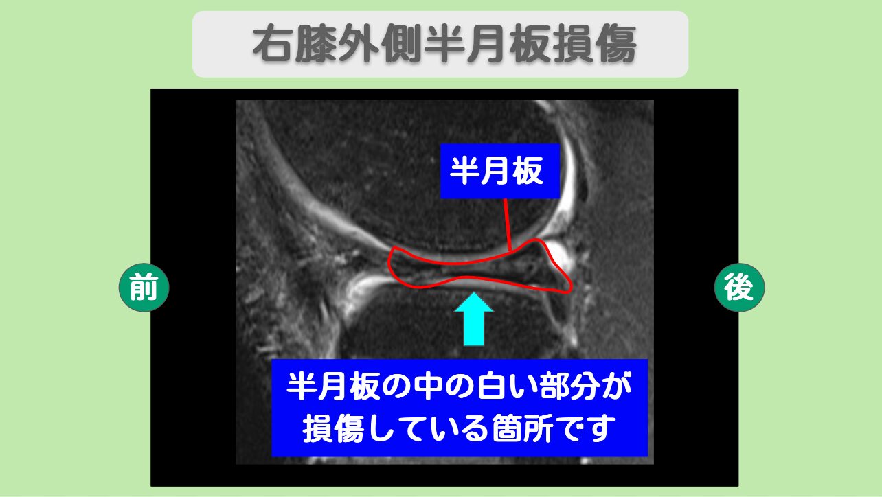 半月板損傷