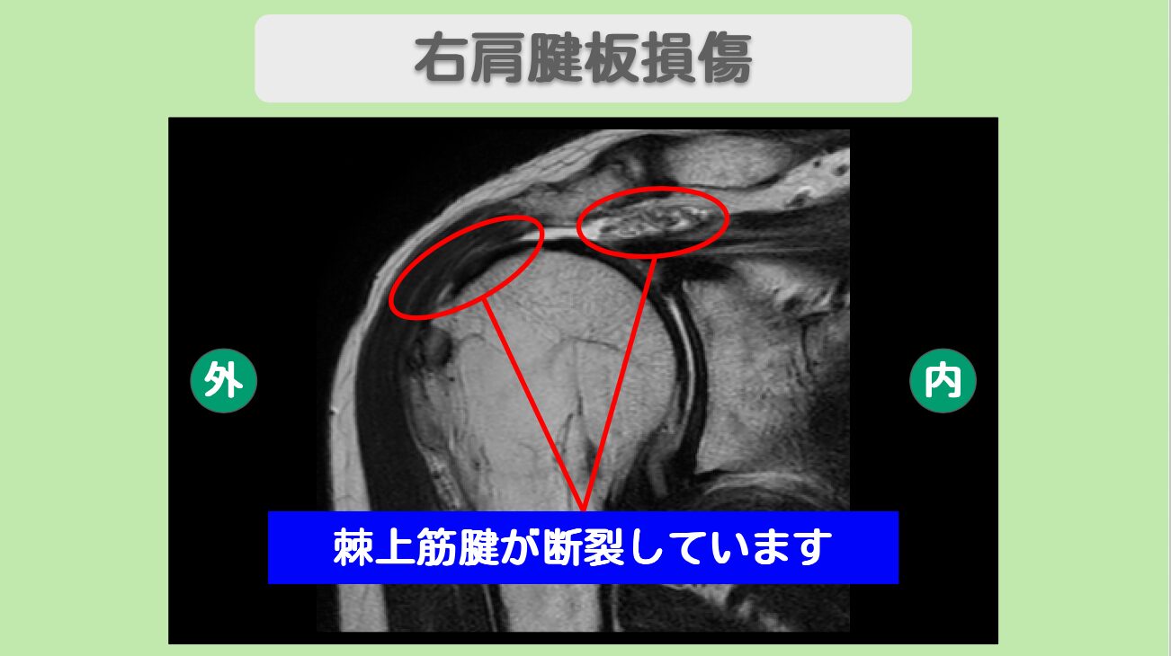 右肩腱板損傷