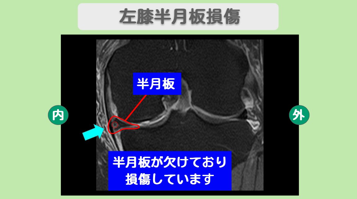 左半月板損傷