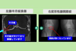 左半月板損傷・右変形性膝関節症