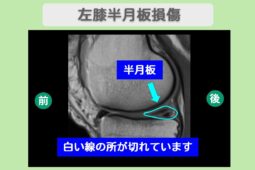 半月板損傷