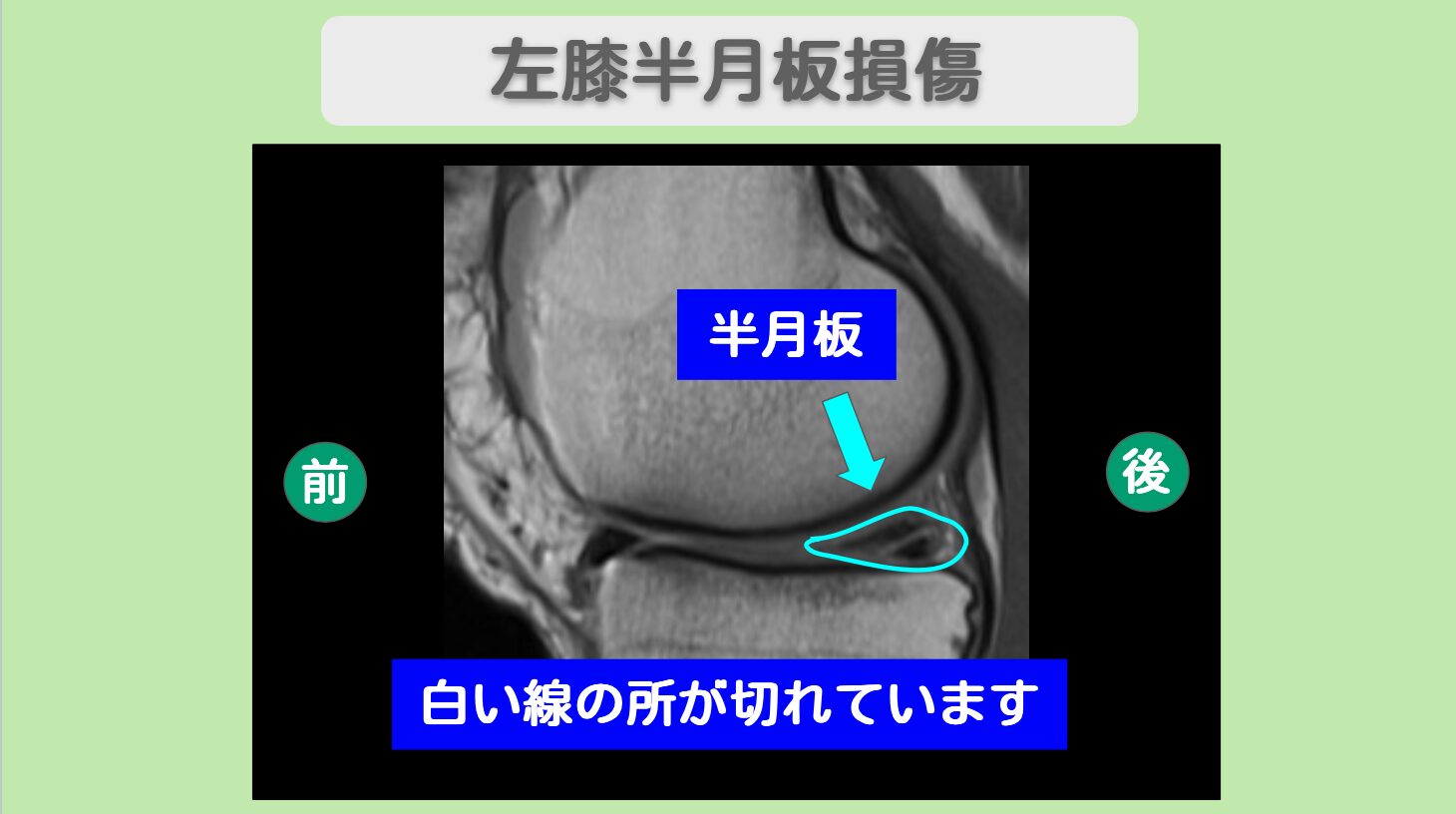 半月板損傷