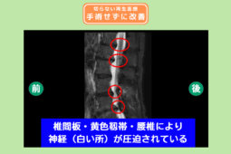 腰椎椎間板ヘルニア