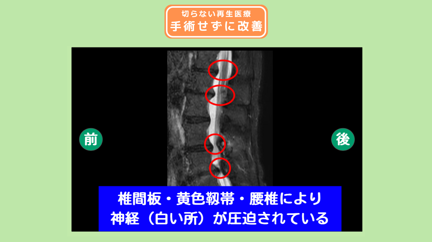 腰椎椎間板ヘルニア