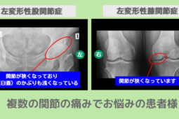 左変形性股関節症・左変形性膝関節症