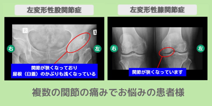 左変形性股関節症・左変形性膝関節症
