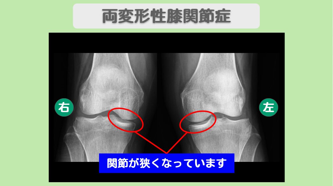 両変形性膝関節症