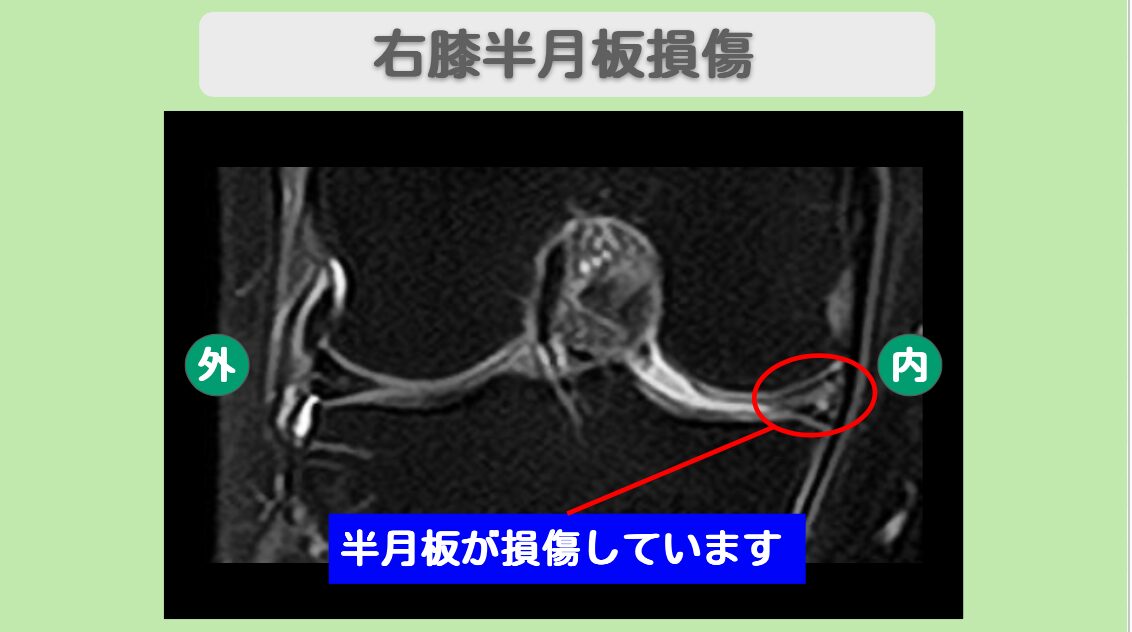 右膝半月板損傷