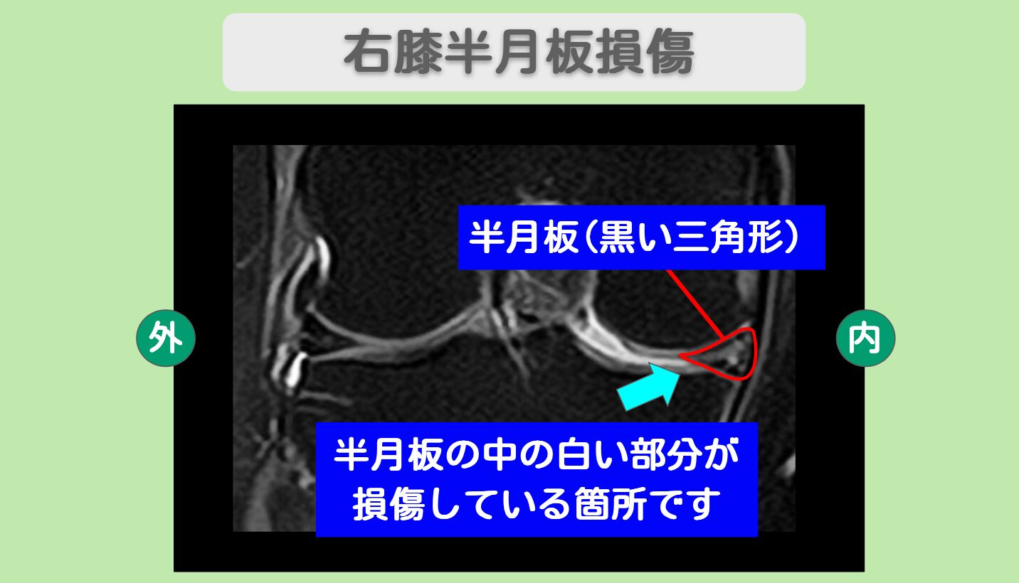 半月板損傷・変形性膝関節症