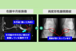 半月板損傷・変形性膝関節症