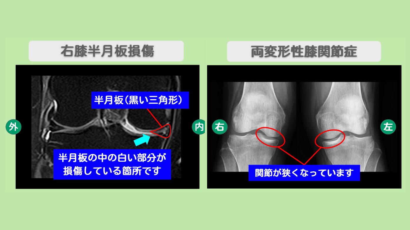 半月板損傷・変形性膝関節症