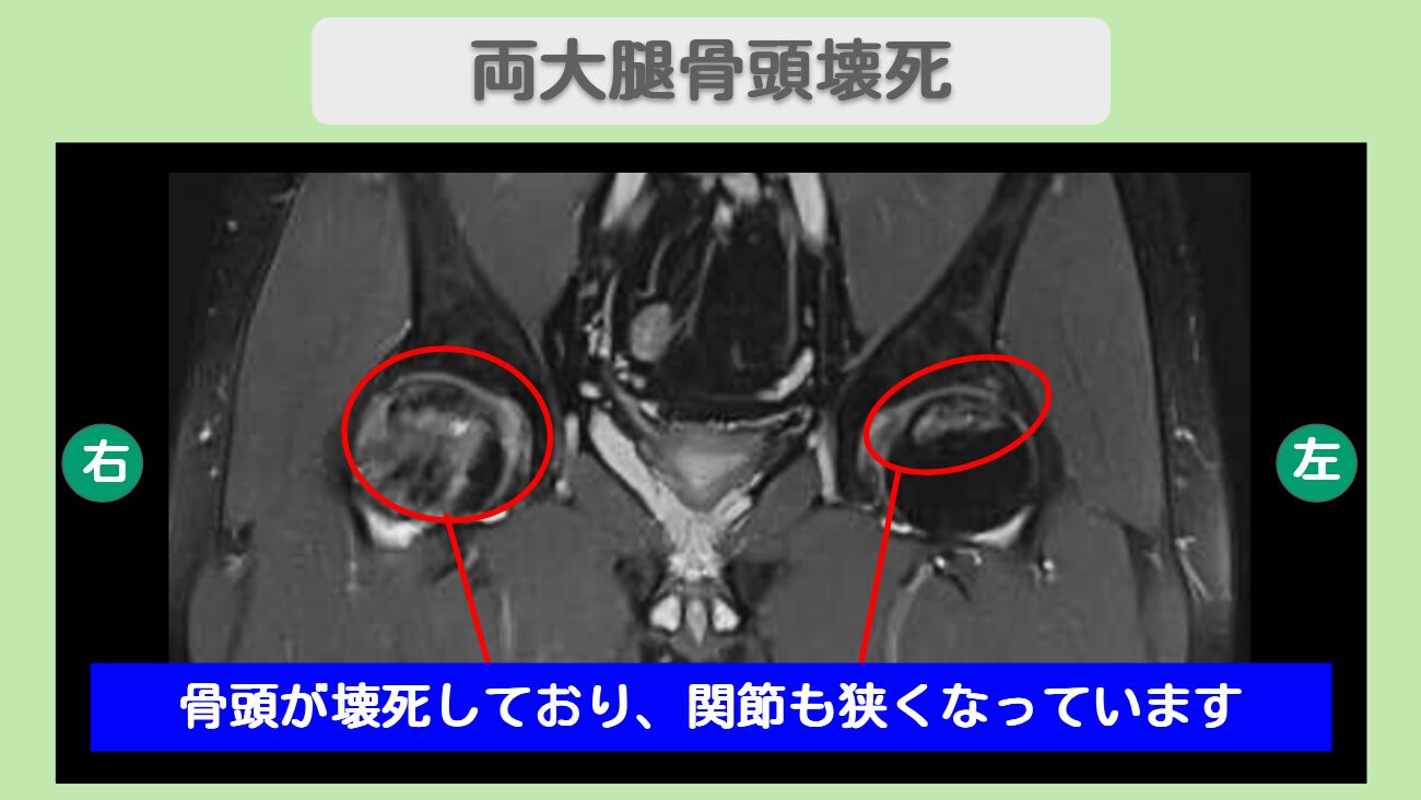 両大腿骨頭壊死症
