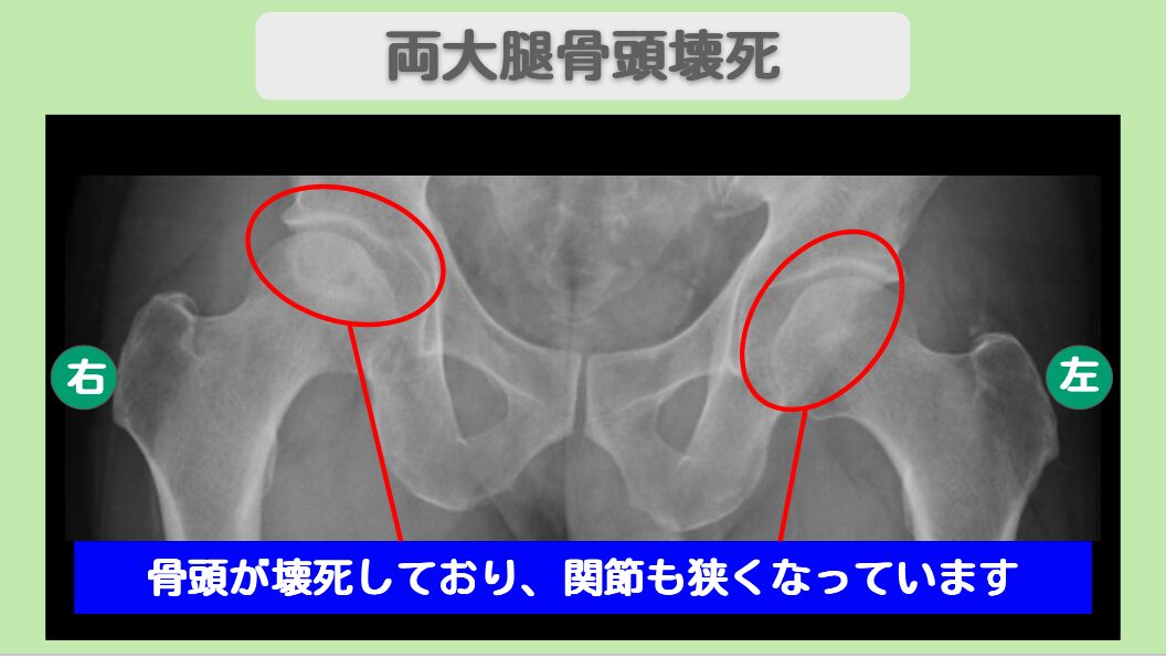 両大腿骨頭壊死症