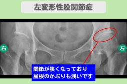 左変形性股関節症