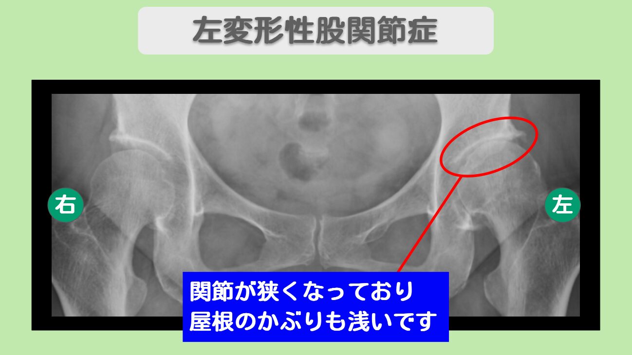 左変形性股関節症