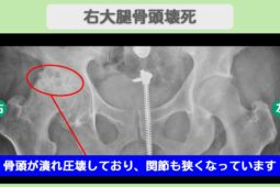 右大腿骨頭壊死症
