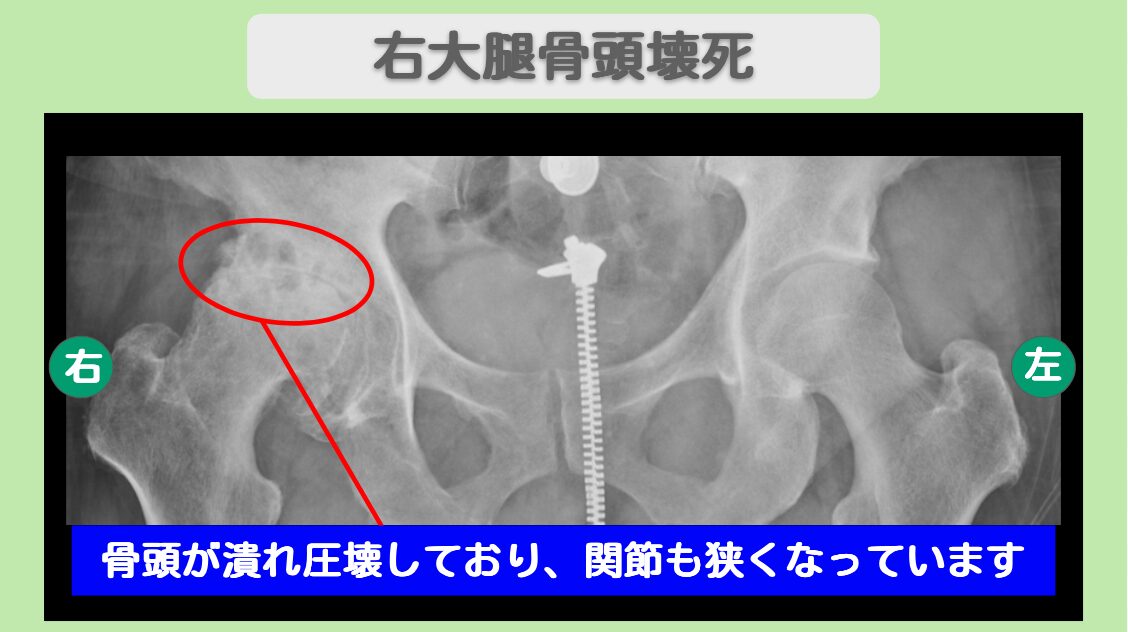 右大腿骨頭壊死症
