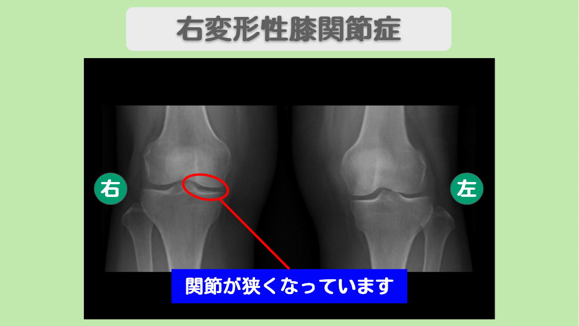 右変形性膝関節症