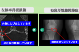 左半月板損傷・右変形性膝関節症