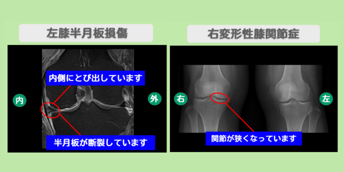 左半月板損傷・右変形性膝関節症