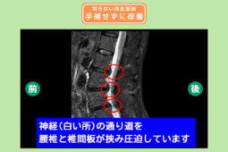 腰椎椎間板ヘルニア