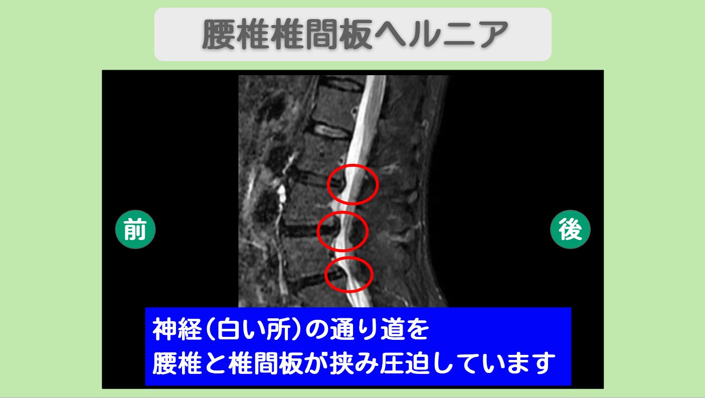 腰椎椎間板ヘルニア