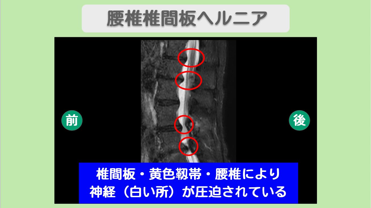 腰椎椎間板ヘルニア