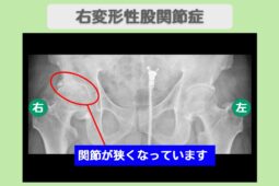 変形性股関節症