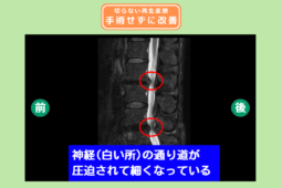 腰椎脊柱管狭窄症