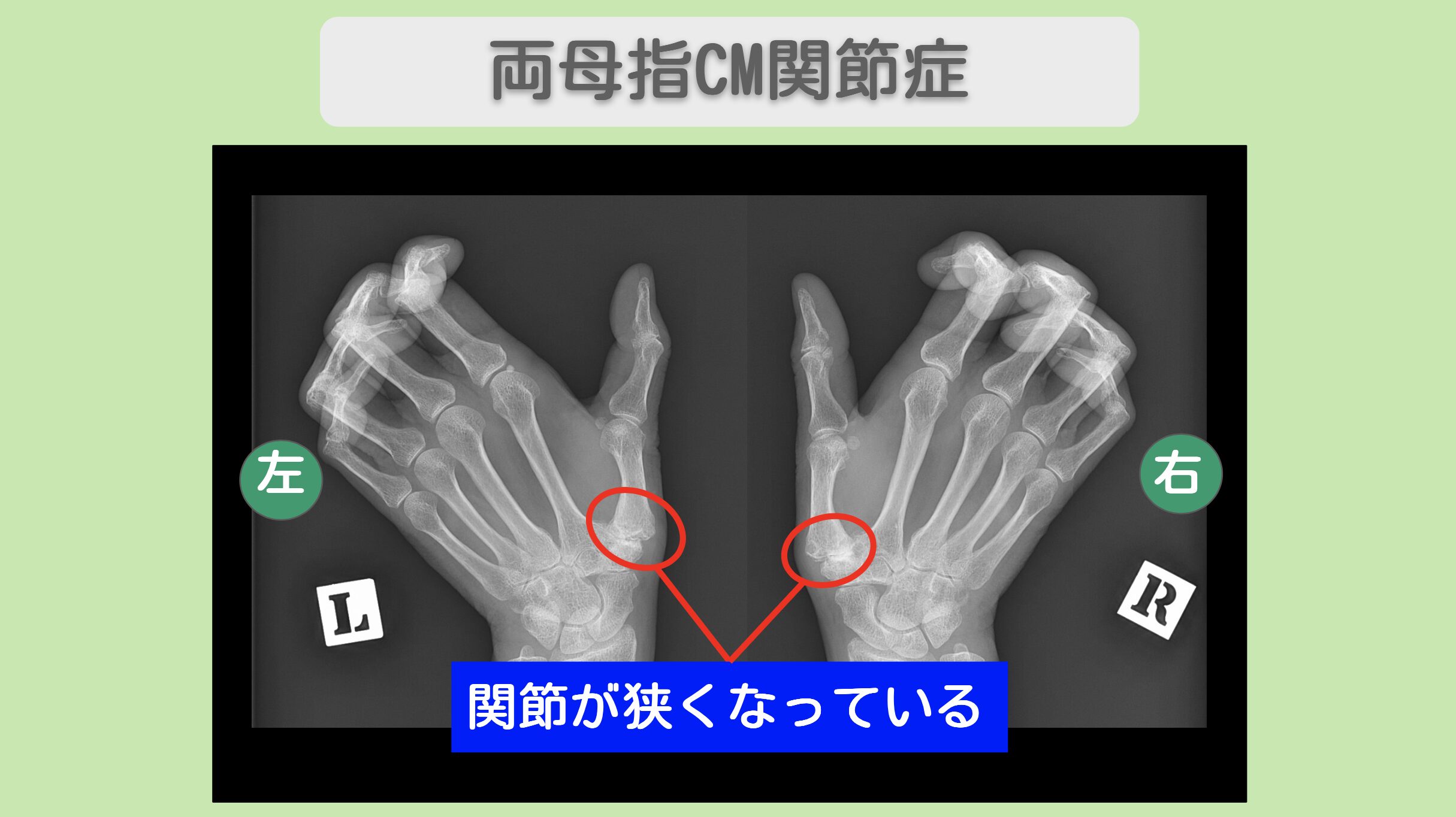 両母指CM関節症