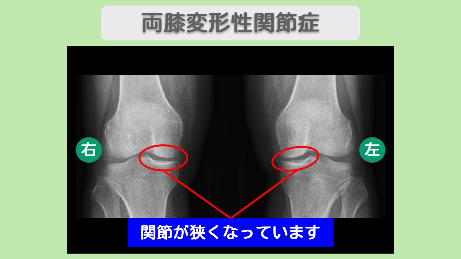 両変形性膝関節症