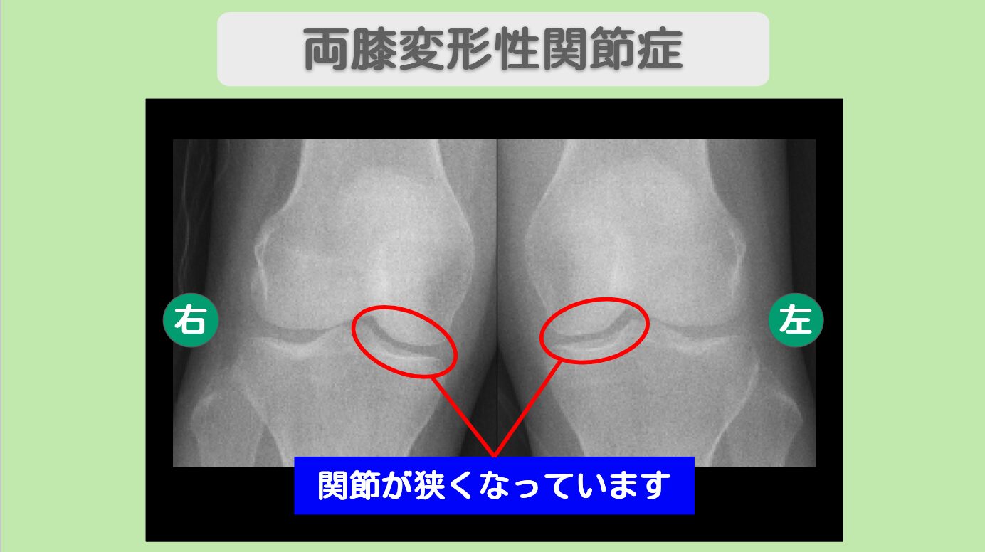 両変形性膝関節症