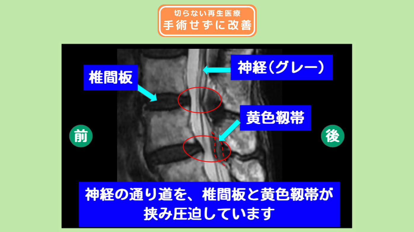 腰椎脊柱管狭窄症