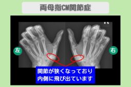両母指CM関節症