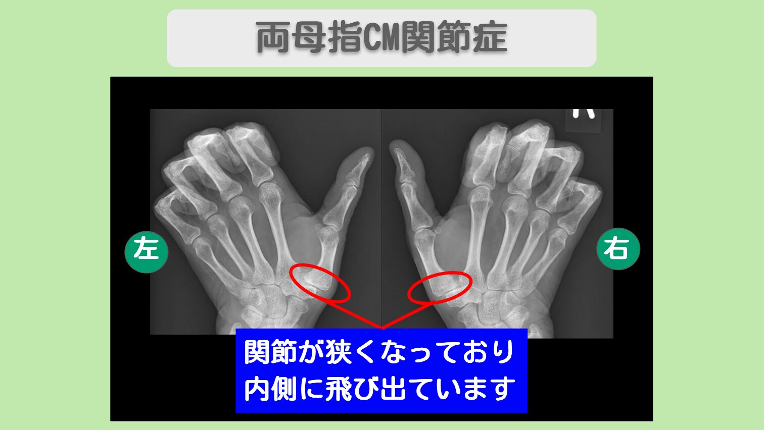 両母指CM関節症