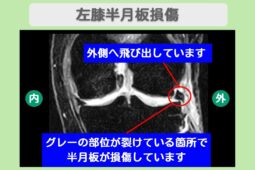 半月板損傷