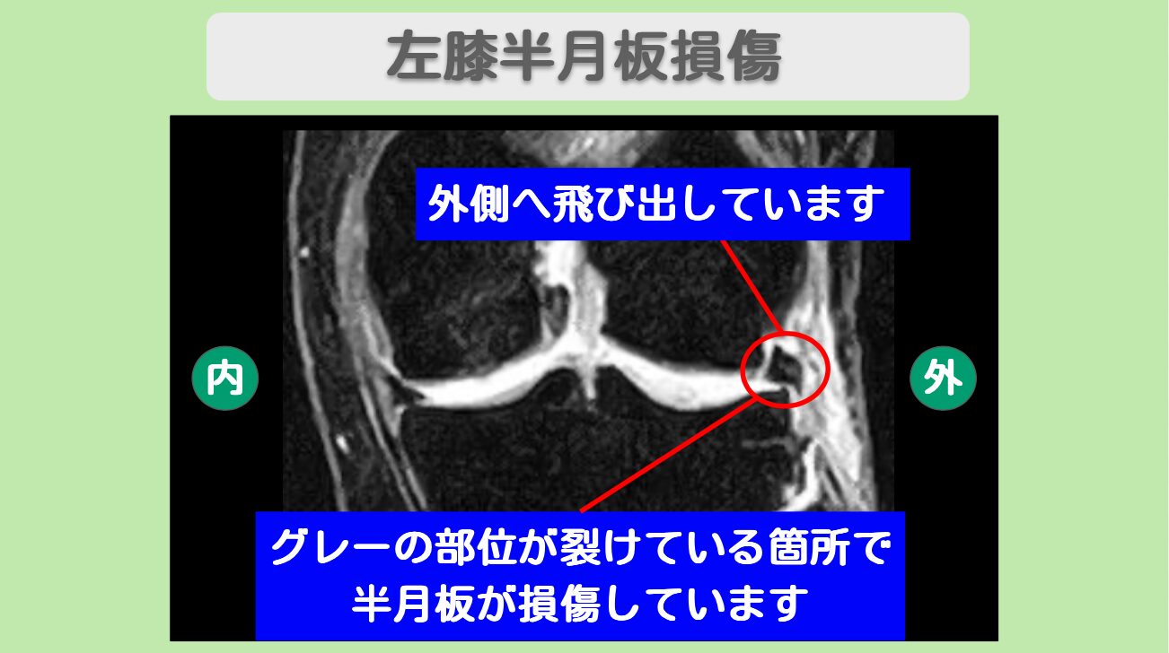 半月板損傷