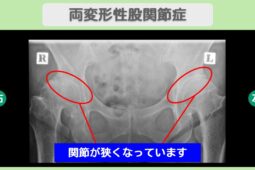 両変形性股関節症