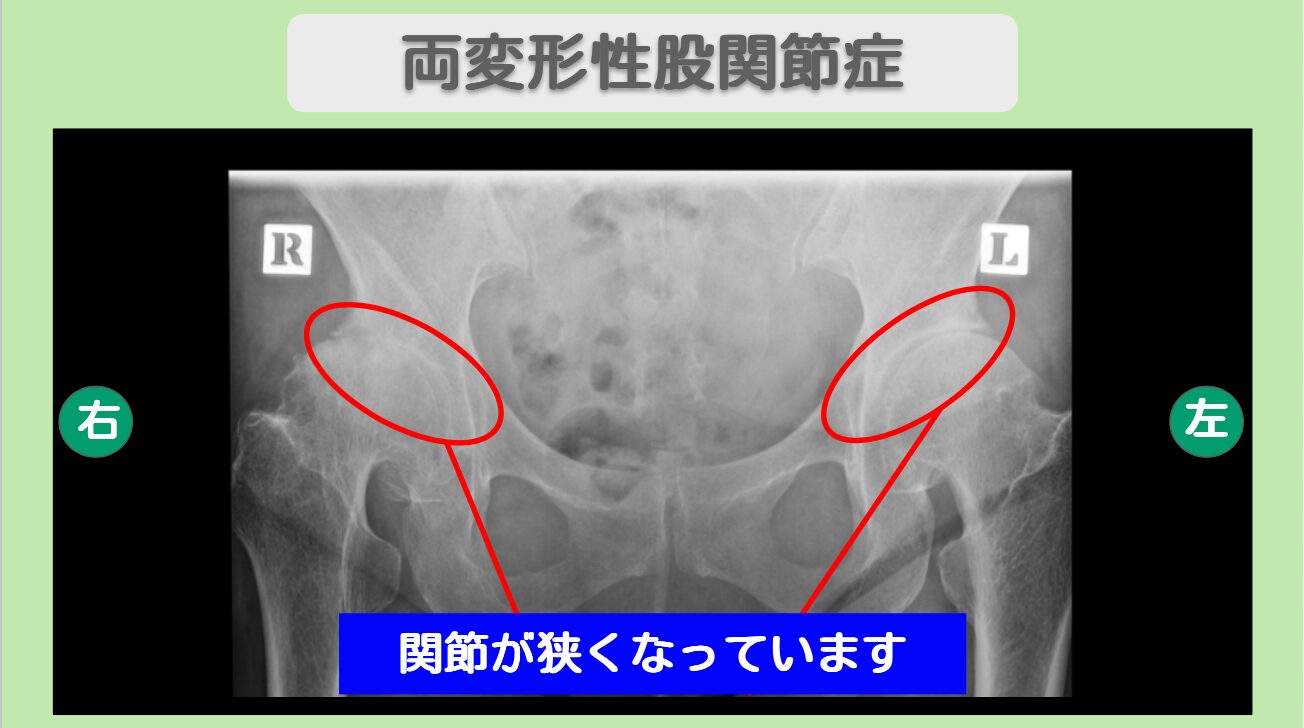 両変形性股関節症
