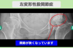 左変形性股関節症