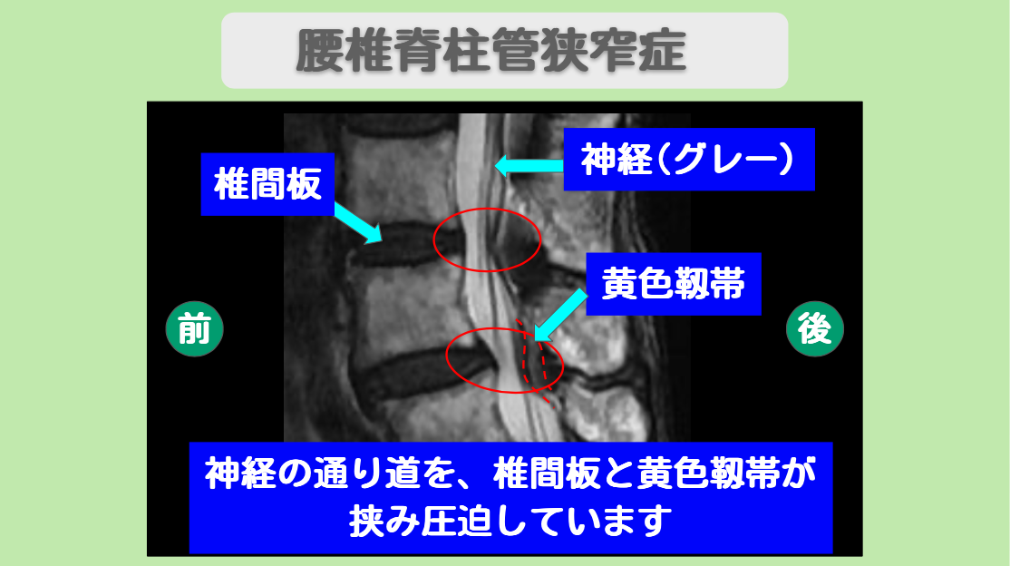 腰椎脊柱管狭窄症