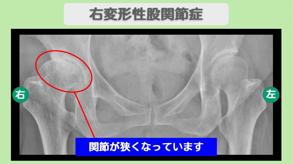 変形性股関節症
