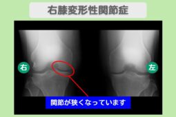 変形性膝関節症