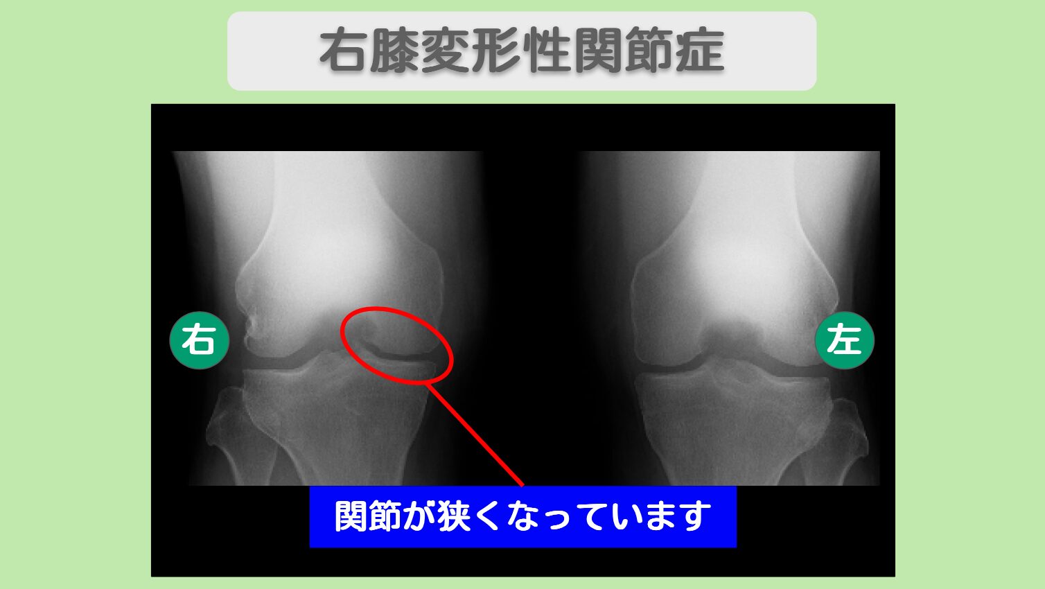 変形性膝関節症