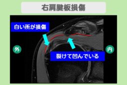 右肩腱板損傷
